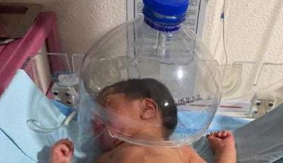 BEBÉ ATENDIDO CON BOTELLA DE PLÁSTICO REVELA CRISIS MÉDICA