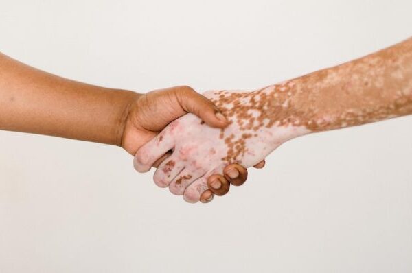 VITILIGO PROVOCA BAJA AUTOESTIMA, ANSIEDAD O DEPRESIÓN