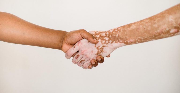 VITILIGO PROVOCA BAJA AUTOESTIMA, ANSIEDAD O DEPRESIÓN