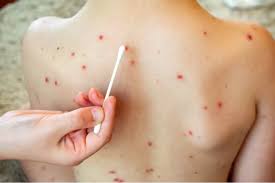 México concentra 42% de casos de sarampión en América; viajes internacionales impulsan brote