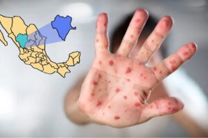 Reportan 185 casos de sarampión en Durango con mayor incidencia en capital y Mezquital