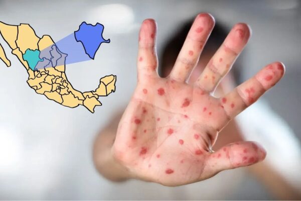 Brote de sarampión en Durango alcanza 185 casos; intensifican vacunación en zonas afectadas