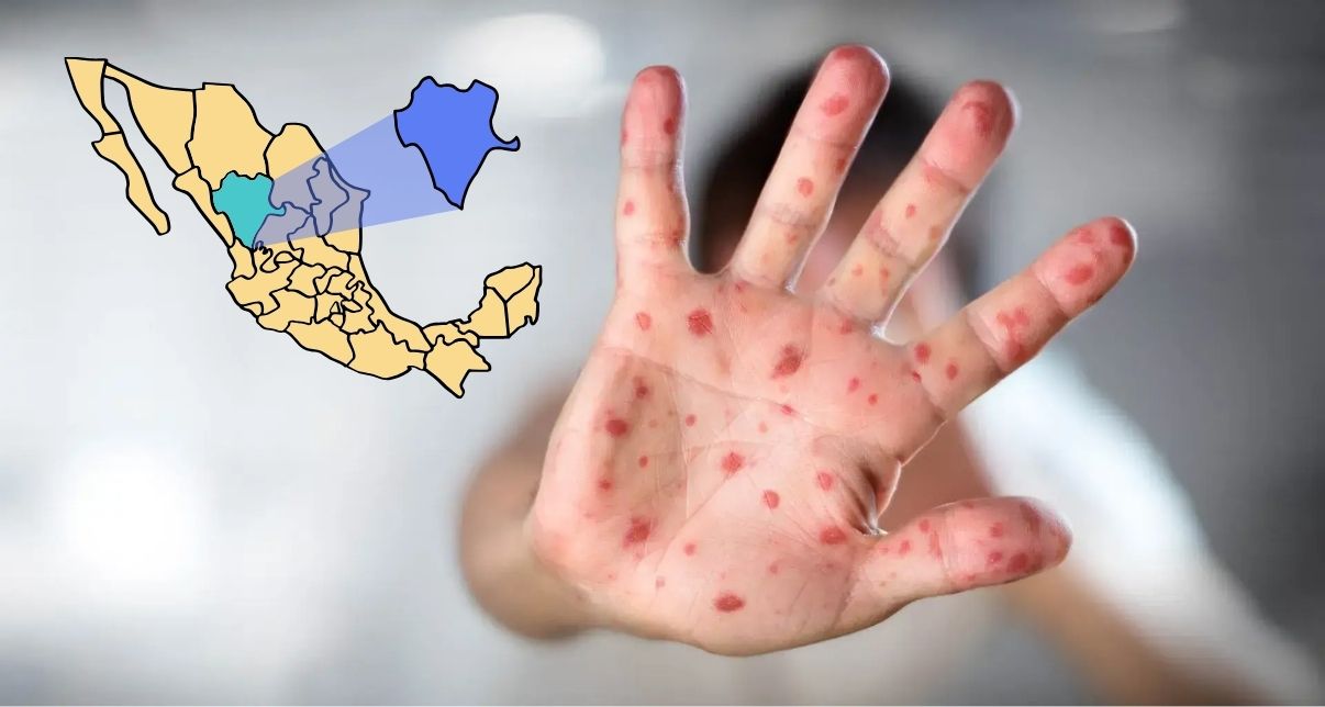Brote de sarampión en Durango alcanza 185 casos; intensifican vacunación en zonas afectadas