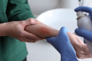 Científicos identifican mecanismo neuronal que vincula el estrés con el agravamiento del eccema