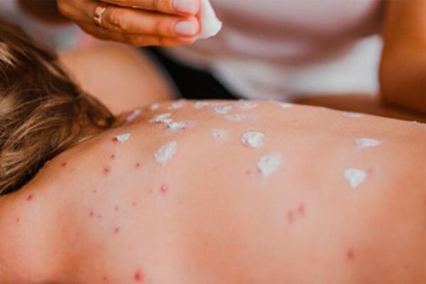 Brote de sarampión en México suma 36 muertes y se expande a 460 municipios