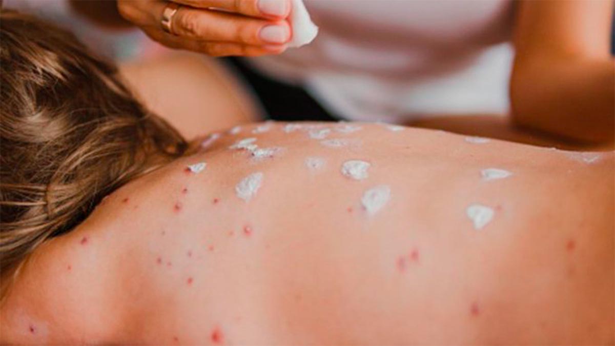 Brote de sarampión en México suma 36 muertes y se expande a 460 municipios