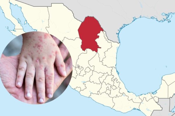 Registran 23 casos de sarampión en Coahuila; Salud llama a pruebas de Hepatitis C