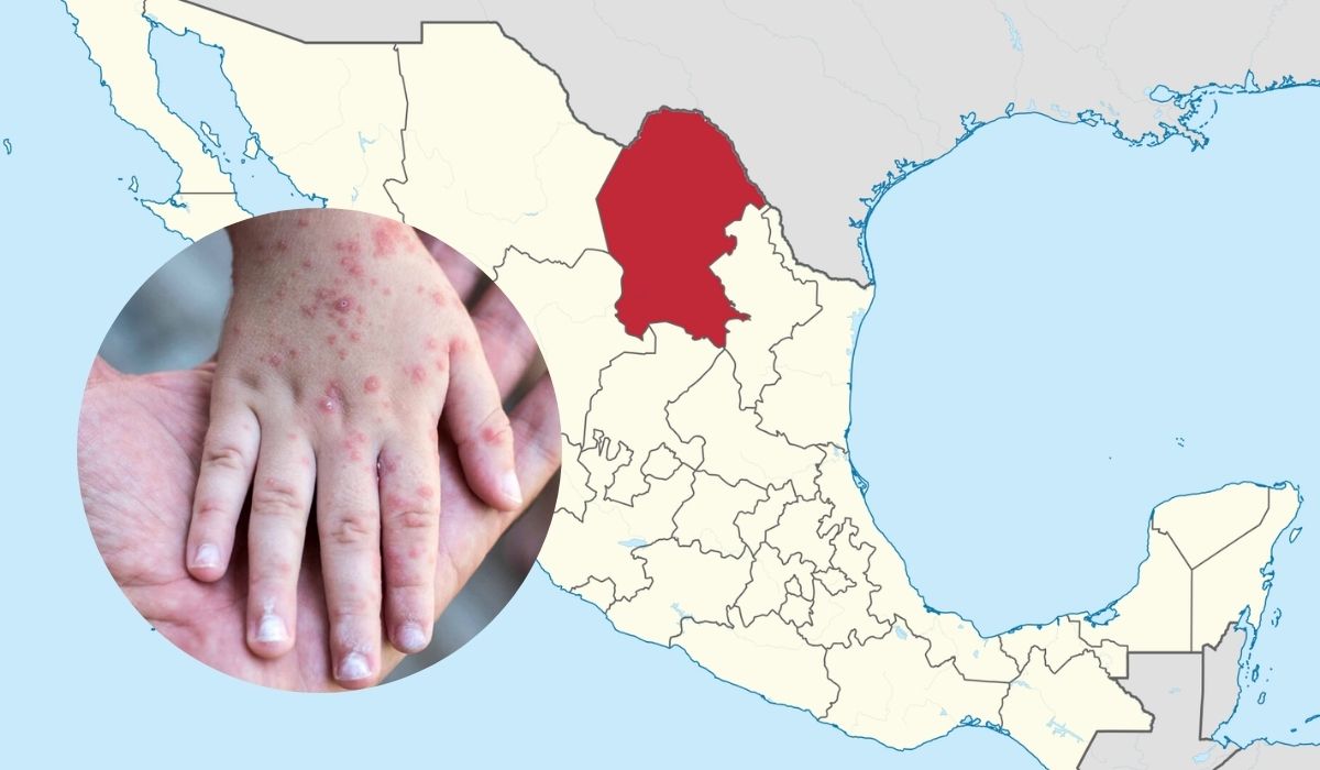 Registran 23 casos de sarampión en Coahuila; Salud llama a pruebas de Hepatitis C