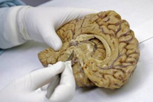 Estudios identifican biomarcadores en sangre para detectar Alzheimer años antes de los síntomas