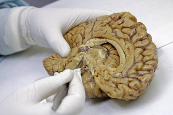 Estudios identifican biomarcadores en sangre para detectar Alzheimer años antes de los síntomas