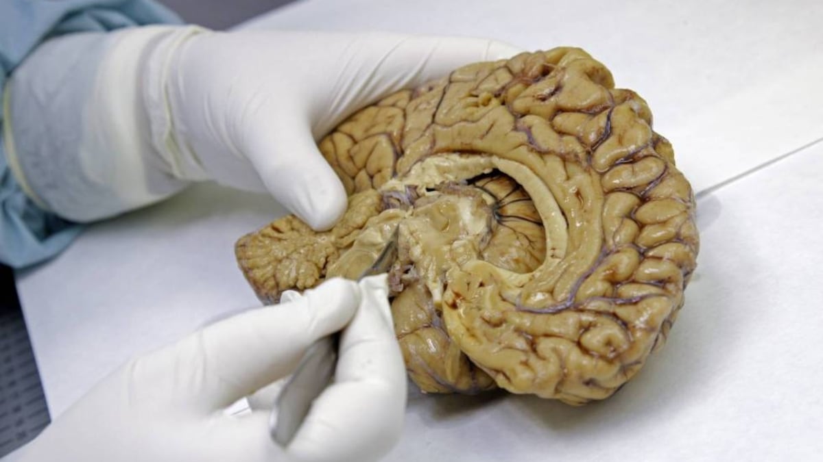 Estudios identifican biomarcadores en sangre para detectar Alzheimer años antes de los síntomas
