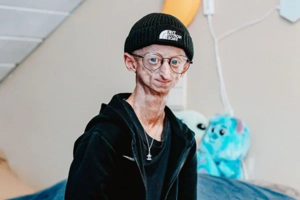 Muere Michiel Vandeweert, influencer belga con progeria que superó el pronóstico de vida